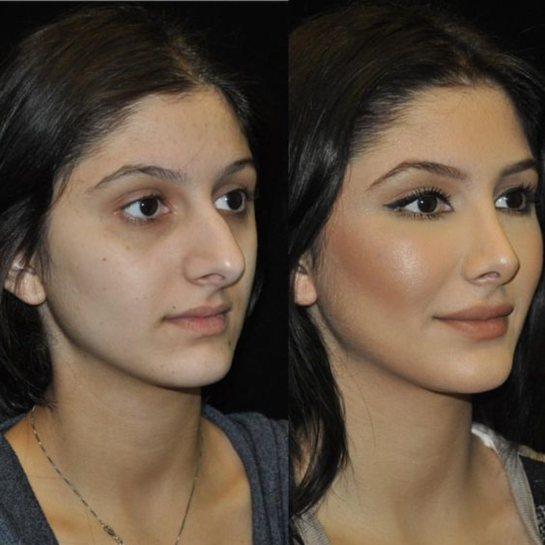Resultado real do RinoSculpt: antes e depois sem cirurgia
